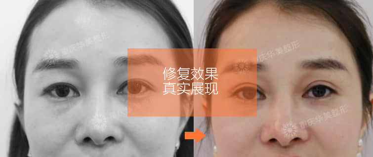 上海双眼皮医院排名_埋线双眼皮图片(3)