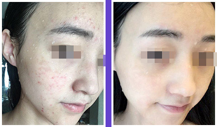 痤疮医院排名_医院常用治痤疮的药膏