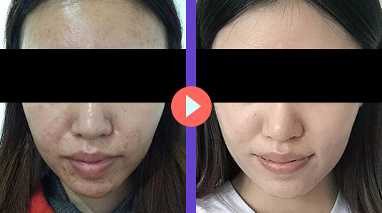 痤疮医院排名_医院常用治痤疮的药膏