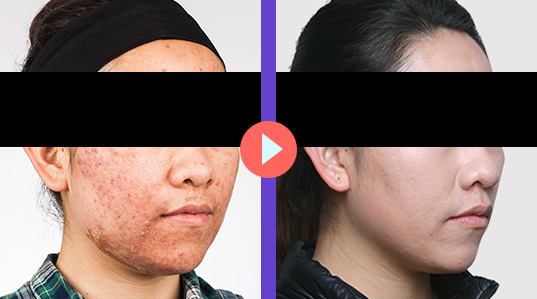 痤疮医院排名_医院常用治痤疮的药膏