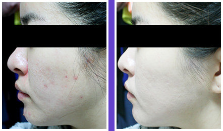 痤疮医院排名_医院常用治痤疮的药膏(2)