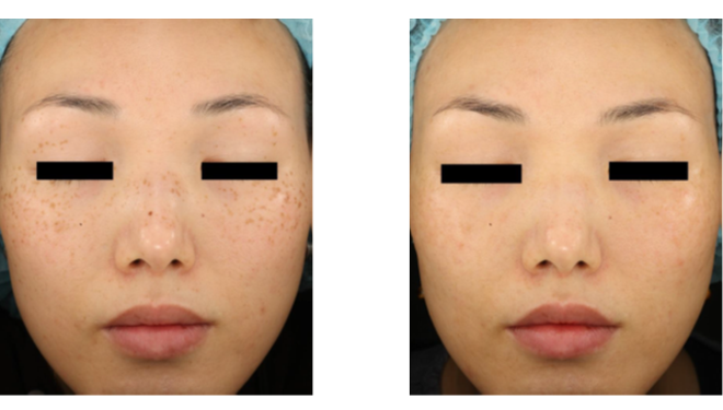 超皮秒祛斑需要多少钱?