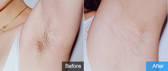脱毛排名_脱毛对比图(3)