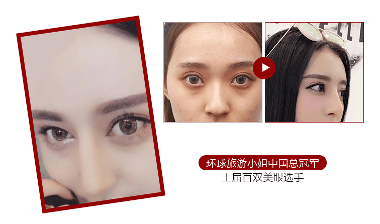 眼部整形医院排名_眼部整形前后对比图