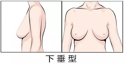 水滴型胸和下垂胸有啥区别 重庆整形医院 重庆整容医院 达拉斯隆鼻 芭比电眼 达芬奇美眼 脂黄金童颜脸