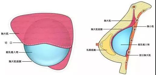 内窥镜下,专家植入假体