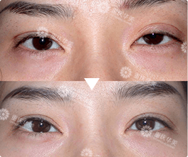 上海双眼皮医院排名_埋线双眼皮图片(3)